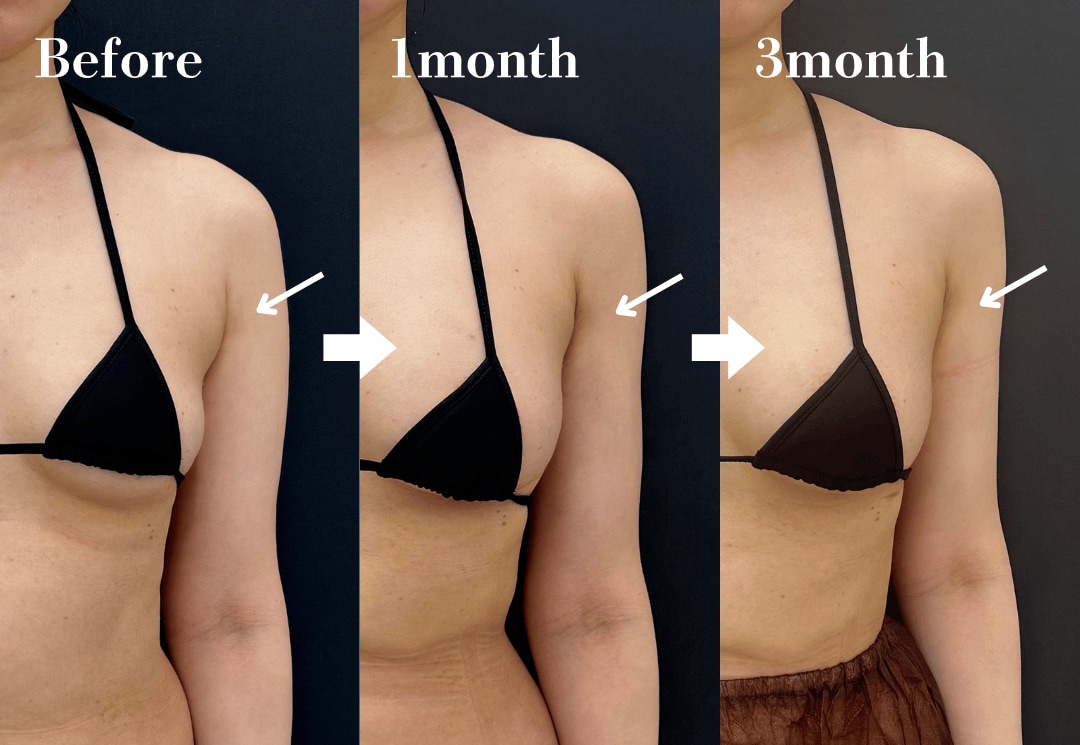 副乳の脂肪吸引は効果ある？