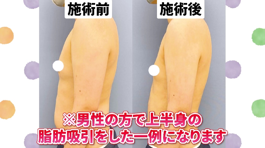 上半身の脂肪吸引で全体的にすっきりした