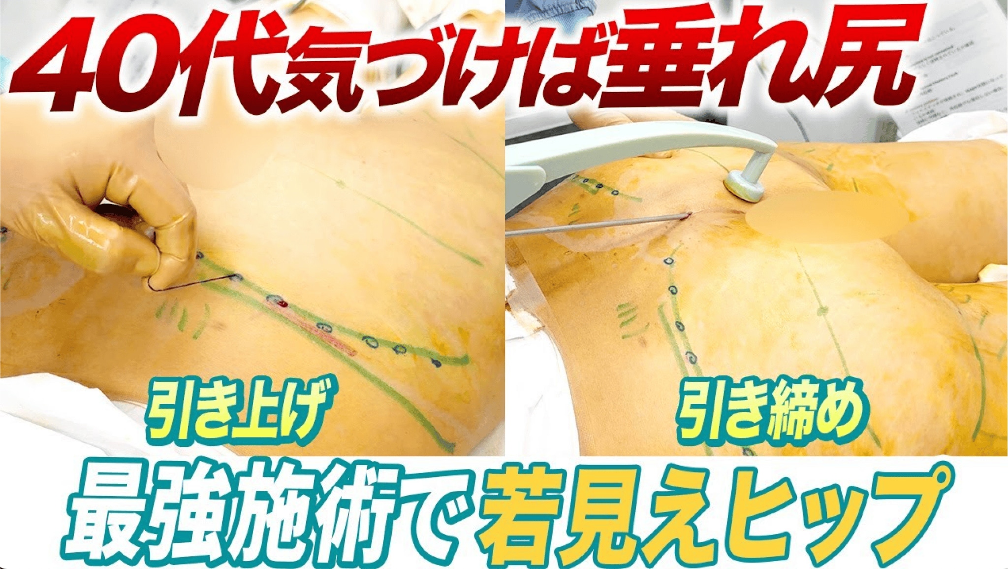 40代のおしりのたるみにはこれ！若見えヒップがかなう施術を紹介