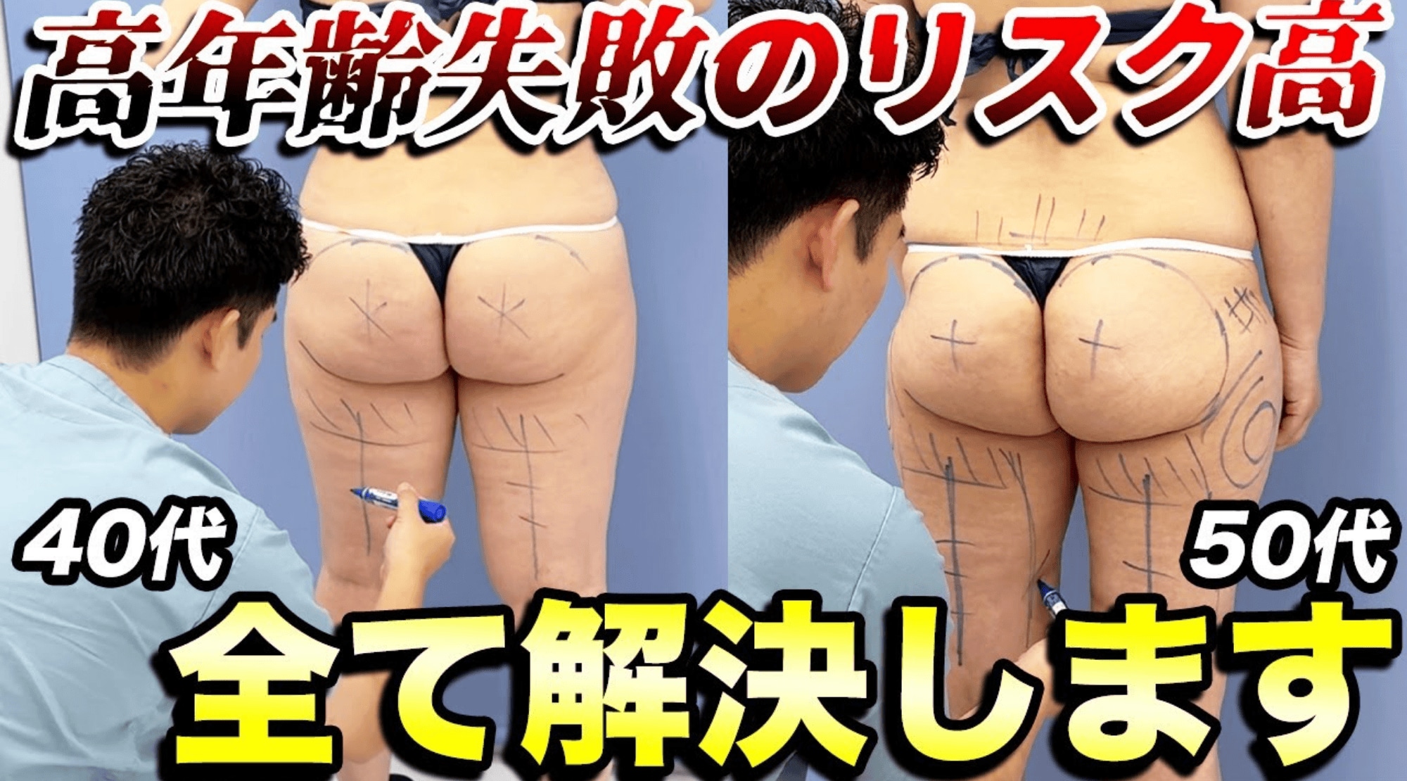 40代・50代の脂肪吸引は手遅れ？痩せないとお悩みの女性4人に密着！