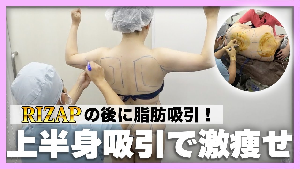 リバウンドしてから痩せない女性が脂肪吸引を決意！上半身を一気に吸引！