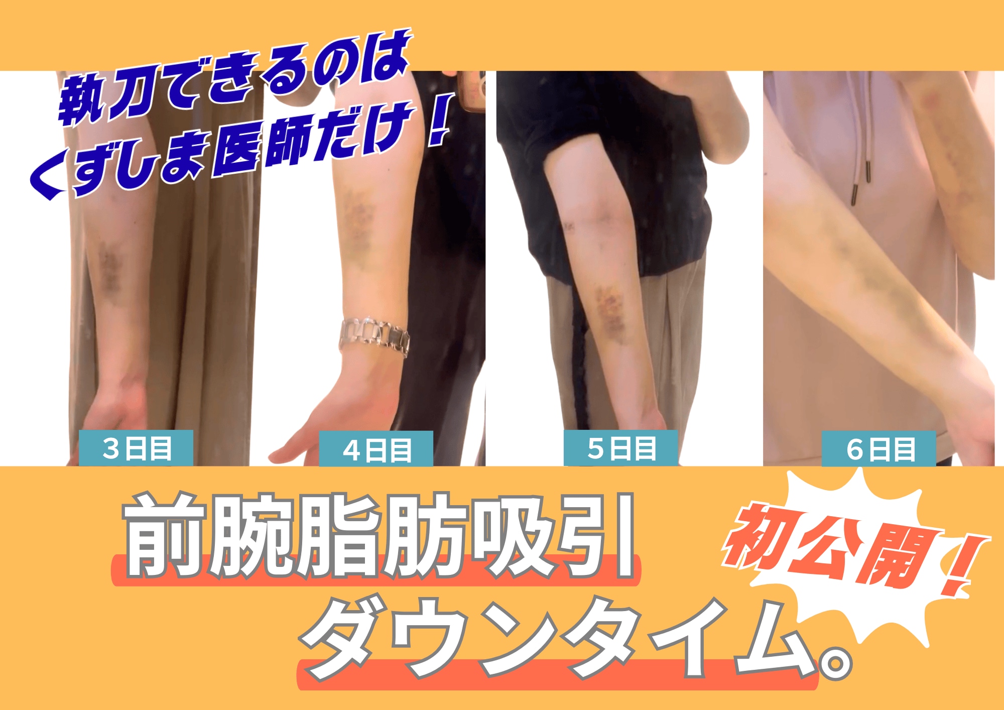 前腕脂肪吸引のダウンタイムってどんなの？腫れ・内出血の経過を解説！