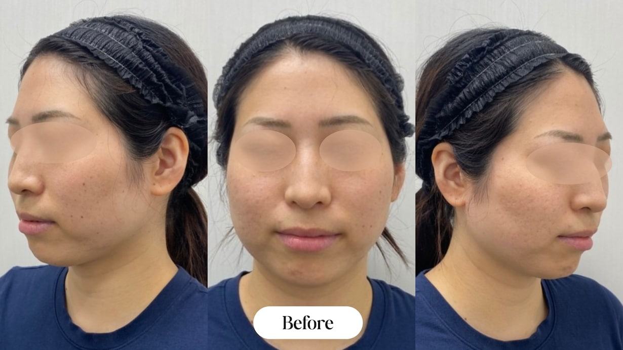 痛み・ダウンタイム・効果…全部見せます！