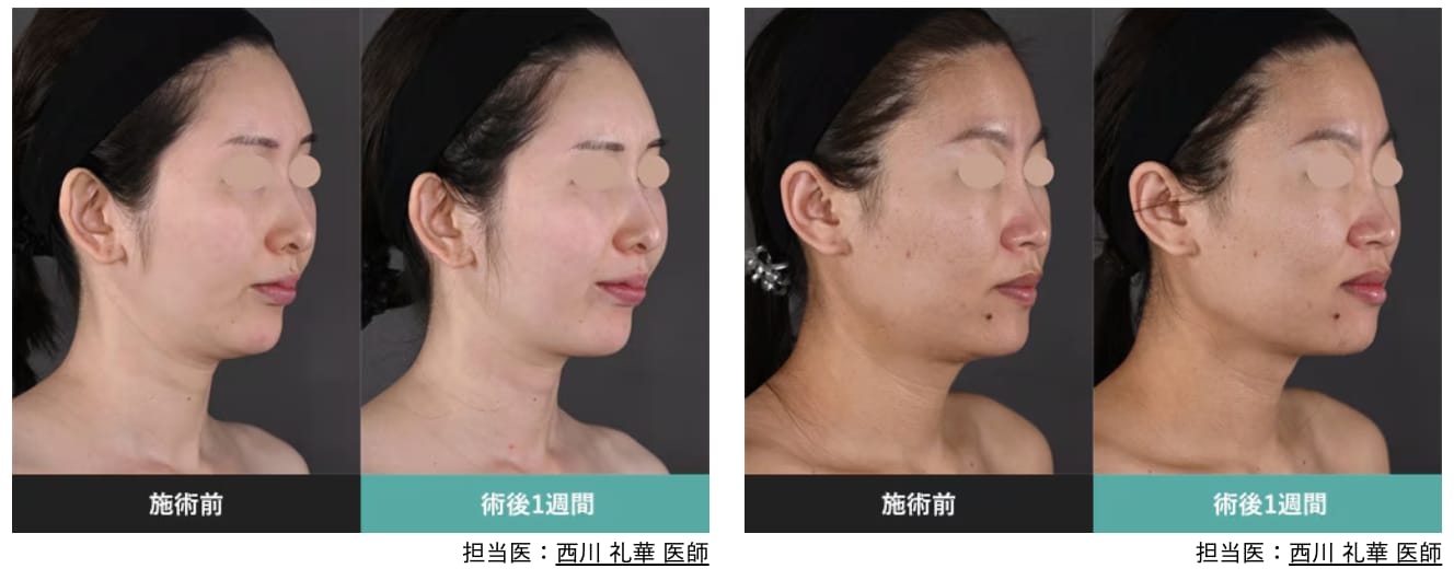 モフィウス8が最強説。