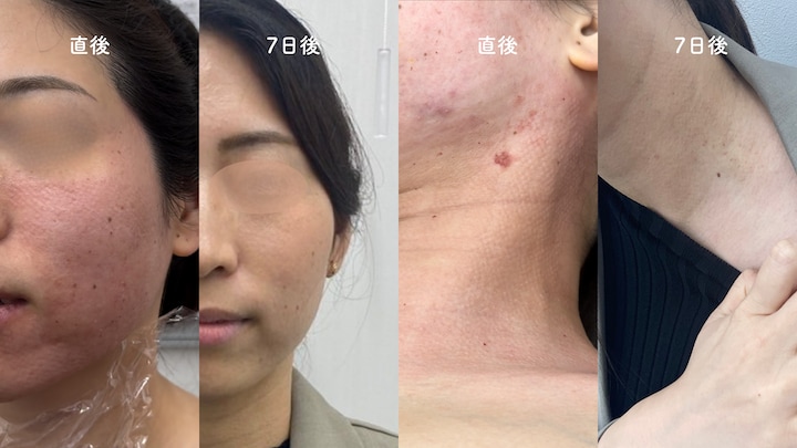 気になるダウンタイムは？