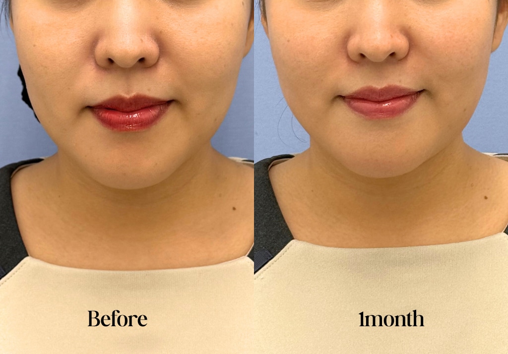 PRP皮膚再生治療の症例写真