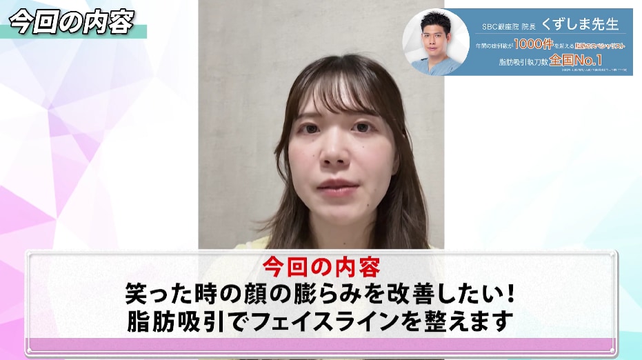 フェイスラインがぼやけていて脂肪吸引を決意
