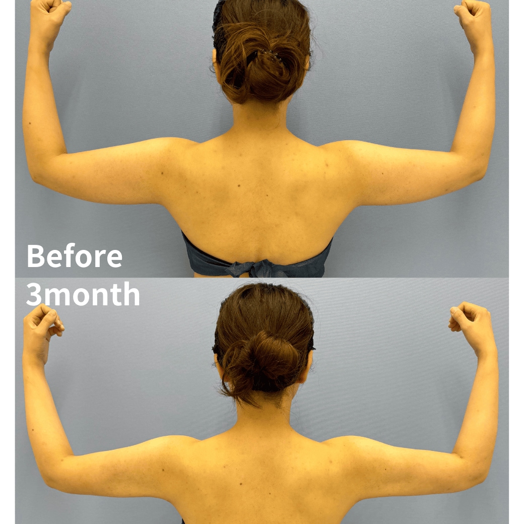 二の腕脂肪吸引