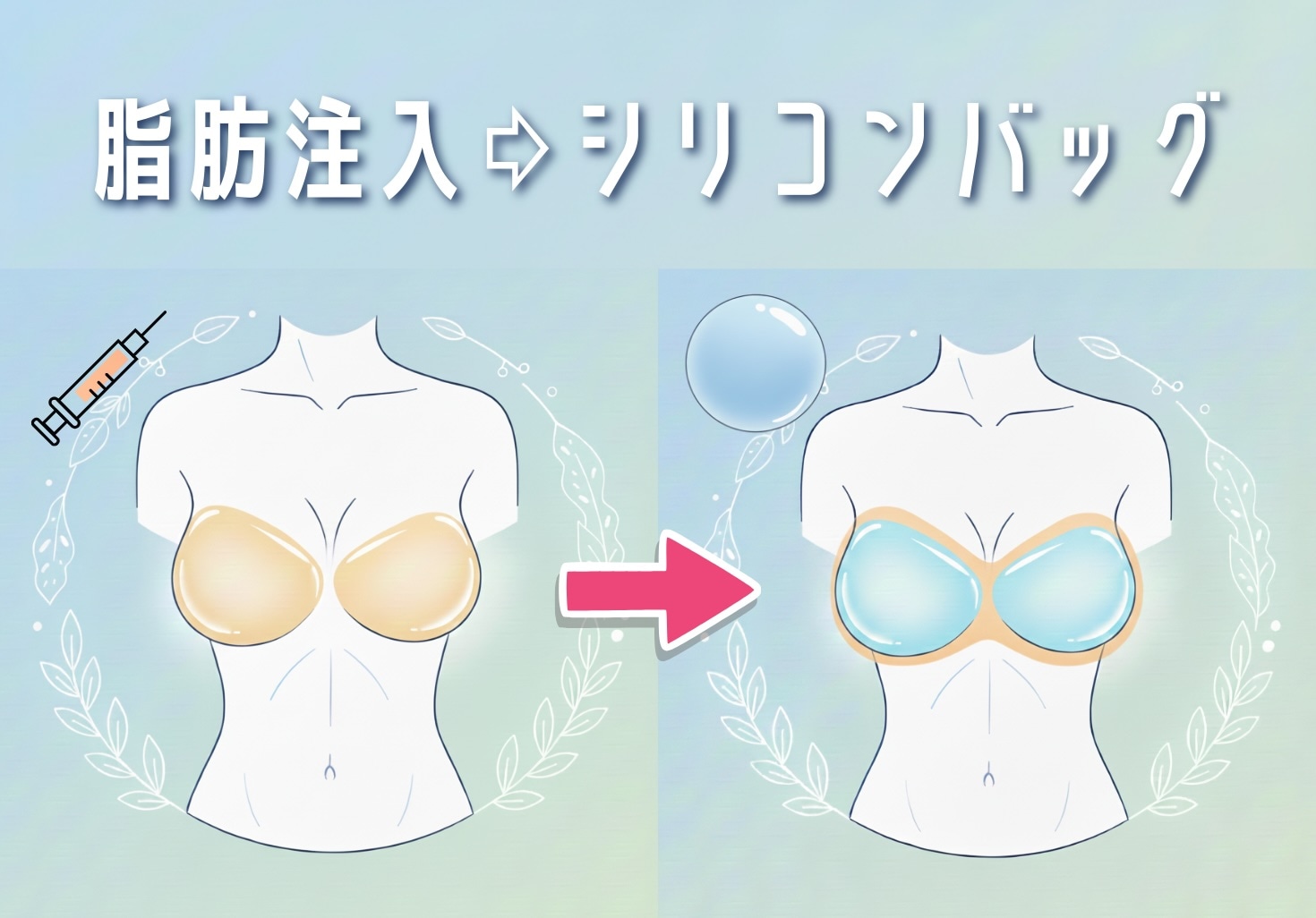 脂肪注入後もっと大きさが欲しい場合