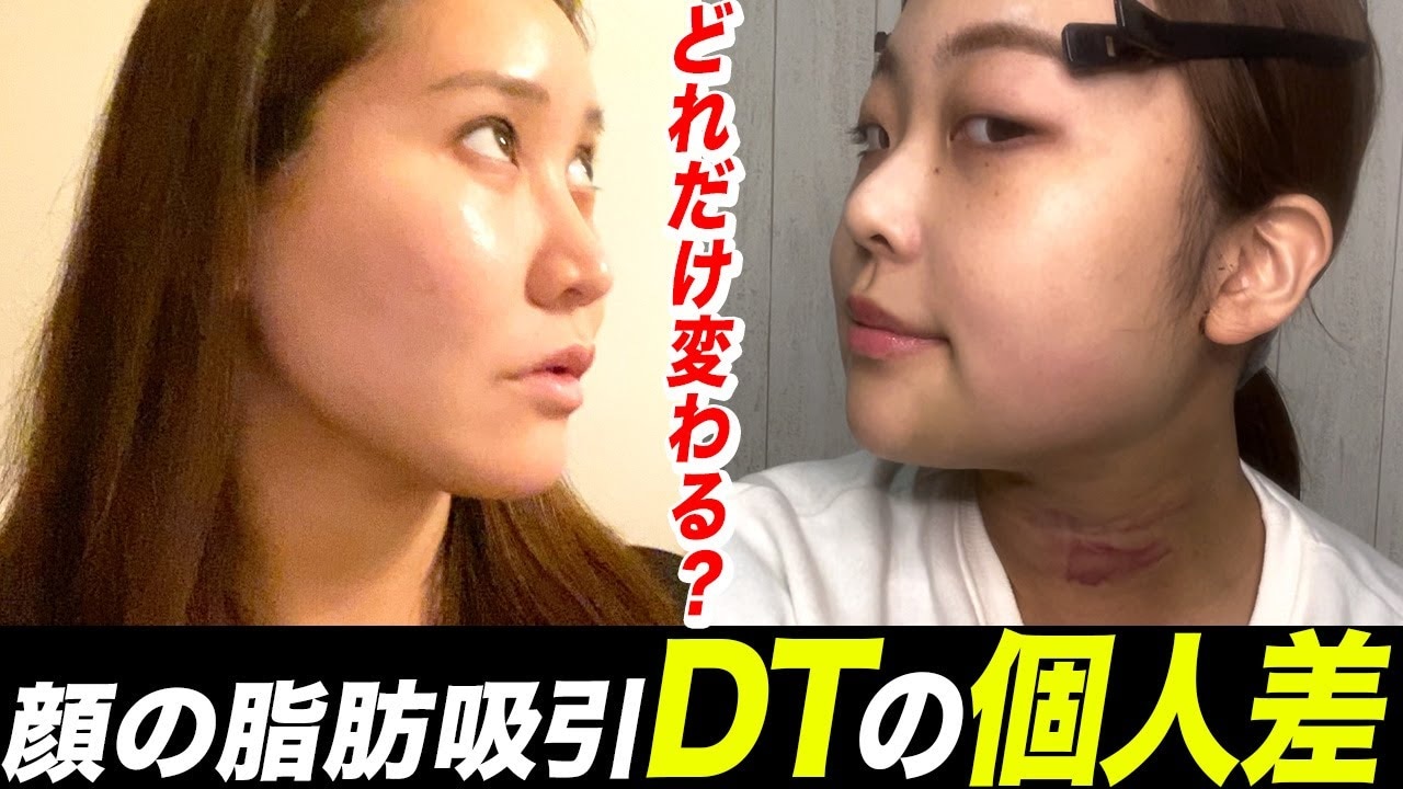 骨切りで皮膚のたるみが気になり脂肪吸引したスタッフの2週間レポート!