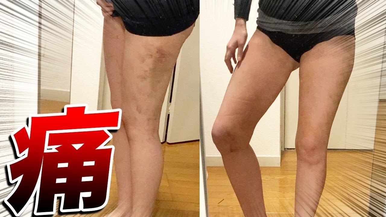 太ももが擦れると痛い…細くならない太ももを脂肪吸引で解消!