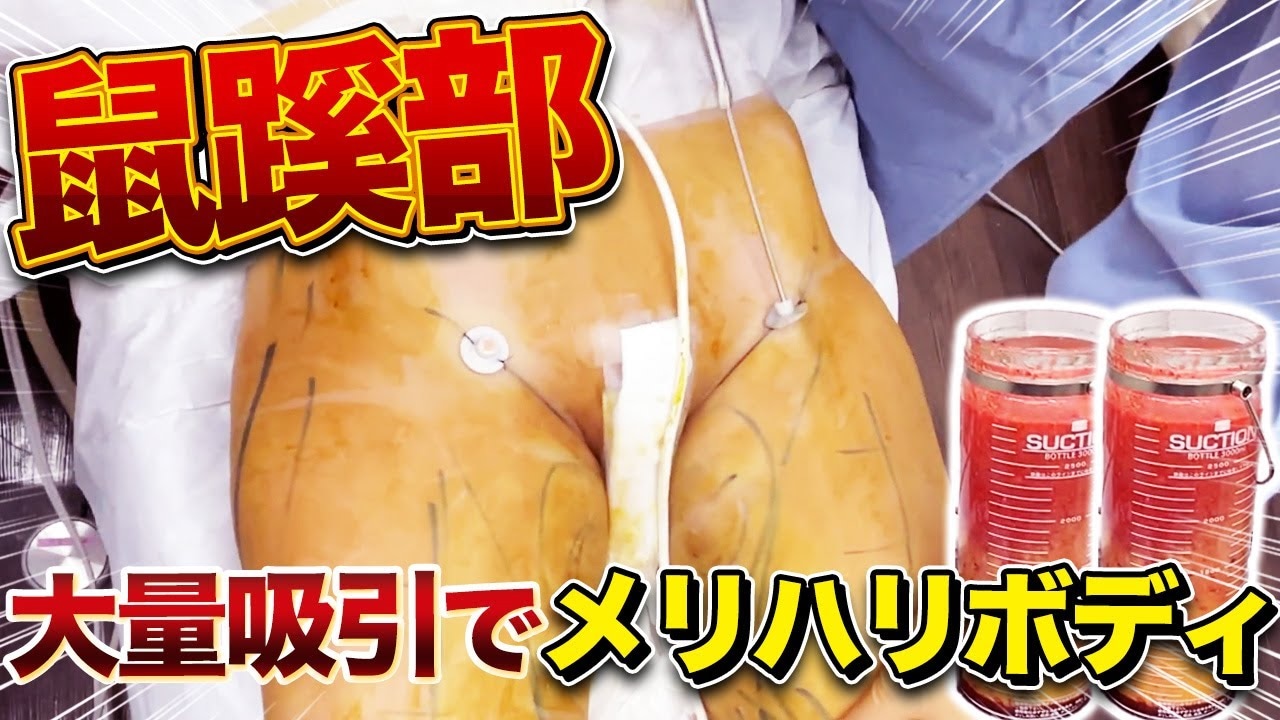 メリハリボディの作り方！脂肪吸引で理想のデザインはかなう？