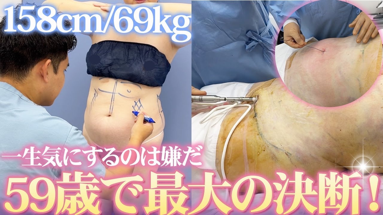 上腹部のぽっこりをなくしたい…59歳女性のお腹の脂肪吸引を紹介！