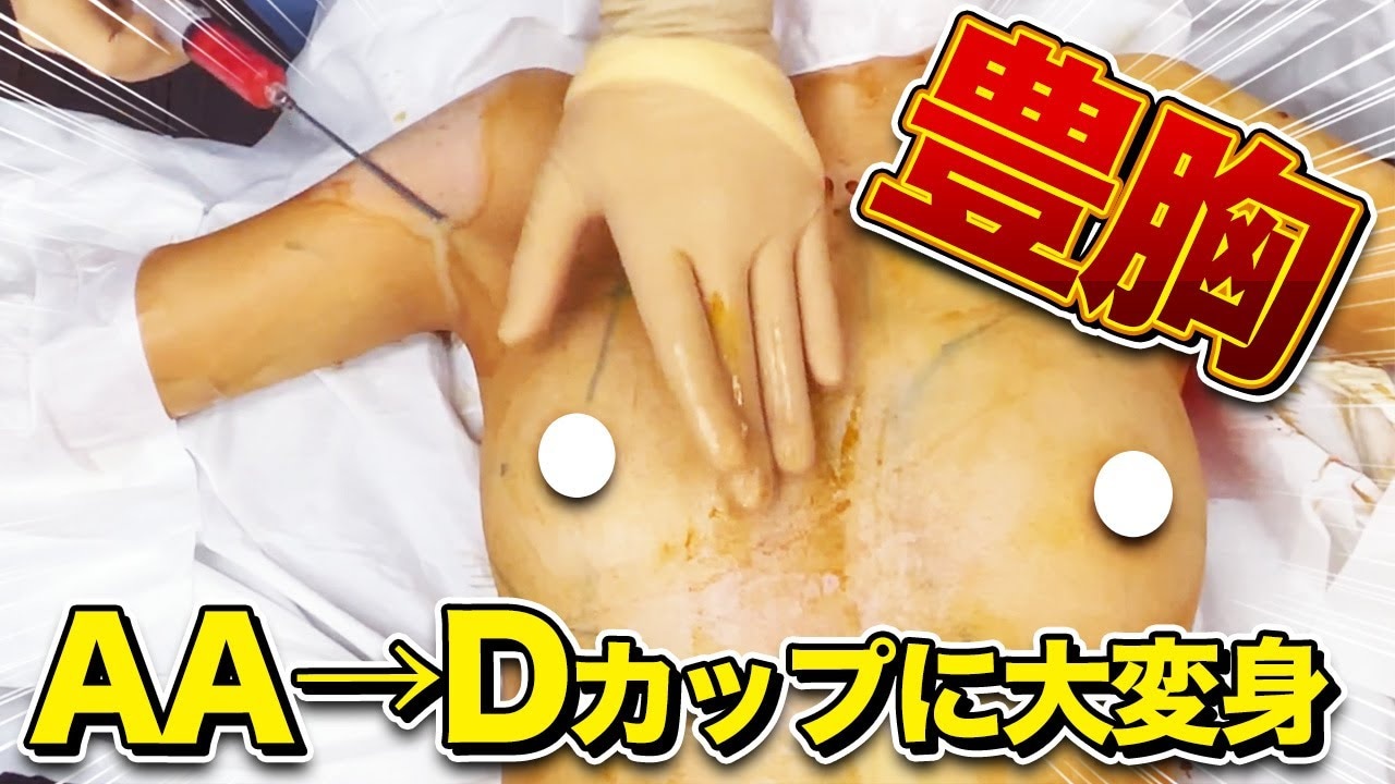 産後の垂れた胸が戻らない…42歳女性の脂肪注入豊胸と乳頭縮小術