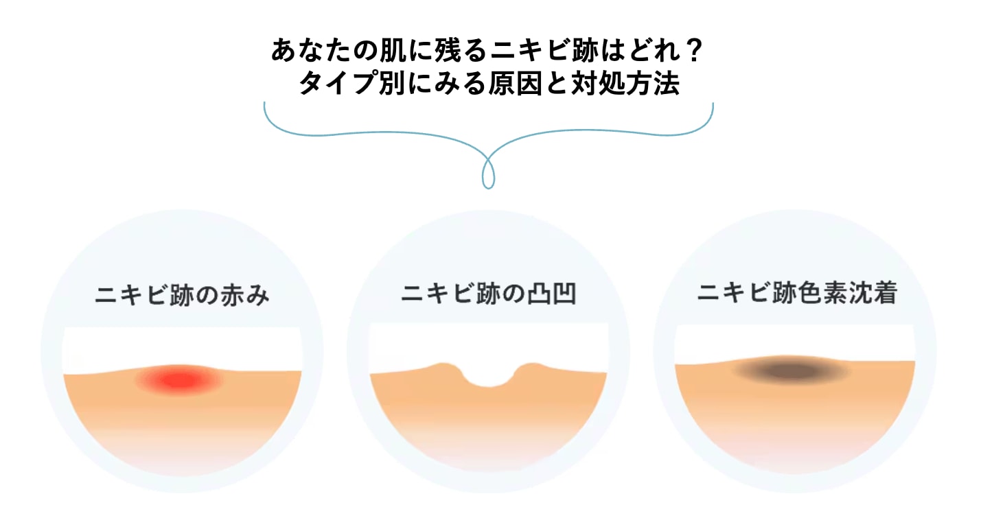 ニキビ撃退の皮膚治療