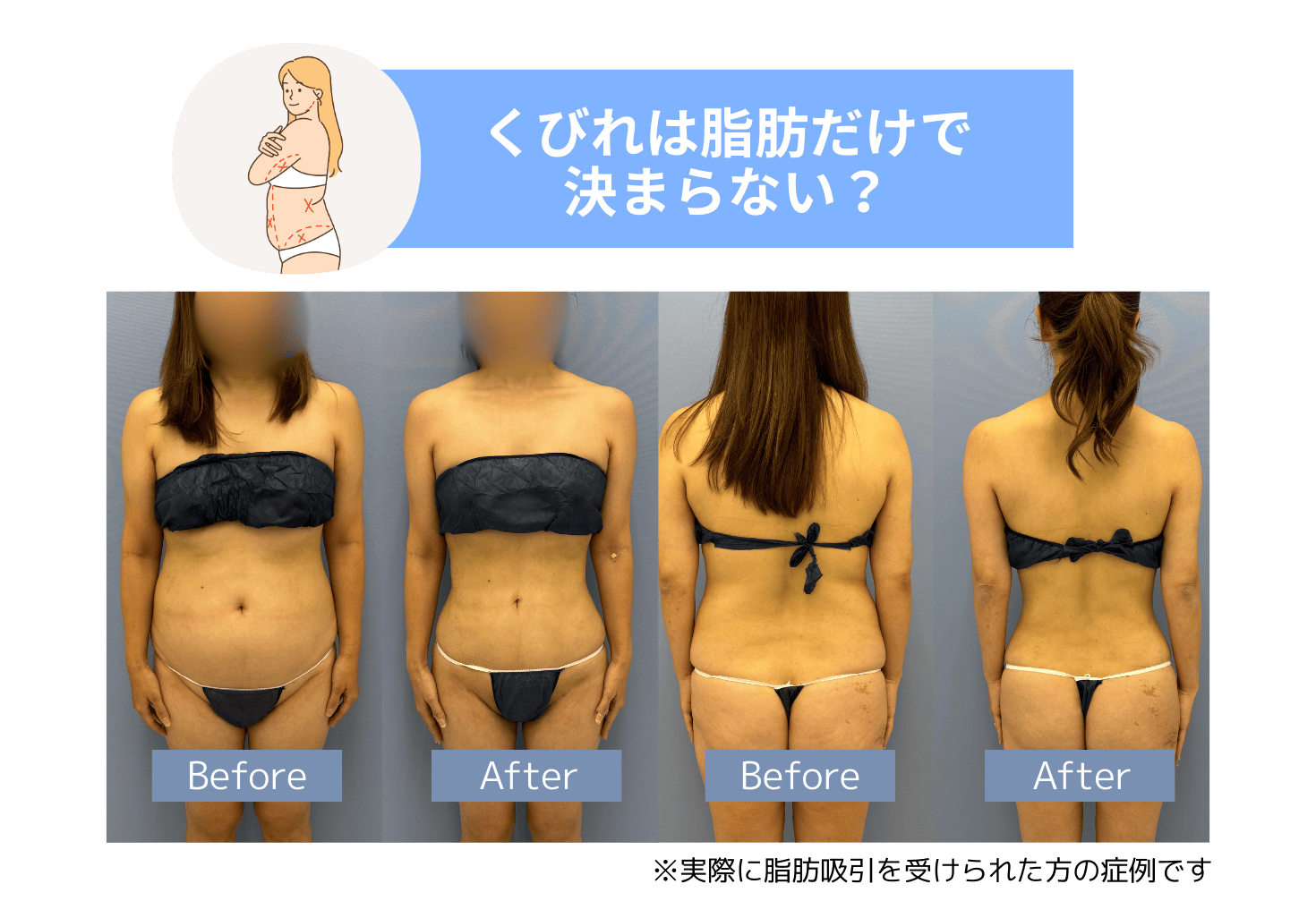 脂肪吸引とリブスカーの相乗効果