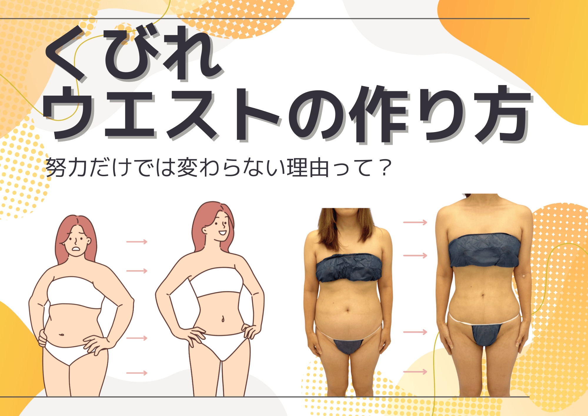 くびれ・ウエストの作り方｜努力だけでは変わらない理由と医療の選択肢