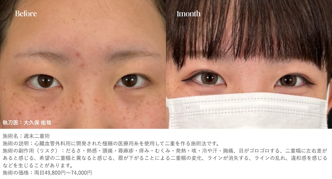 湘南美容クリニック独自の人気埋没法