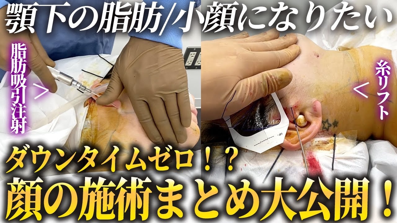 顎下をスッキリさせたいときにおすすめの施術とは?2つの症例を紹介!