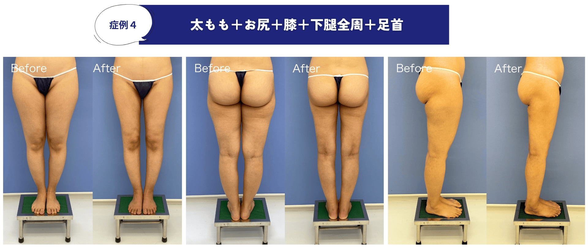 ふくらはぎ・脛 (すね) の脂肪吸引の名医は？東京で受けるなら葛島医師 