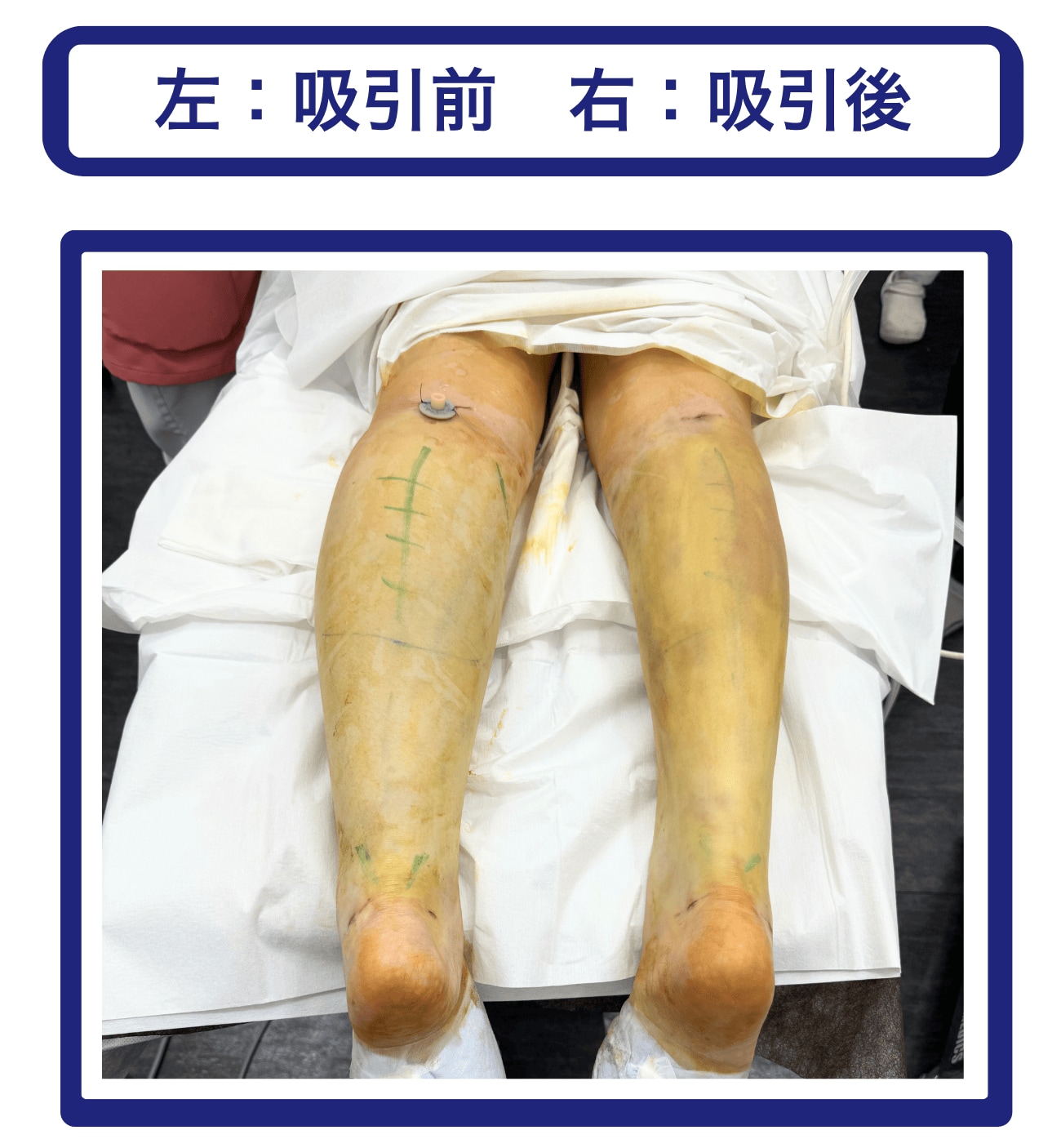 ふくらはぎ・脛（すね）の脂肪吸引で多くの脂肪を吸引できた症例