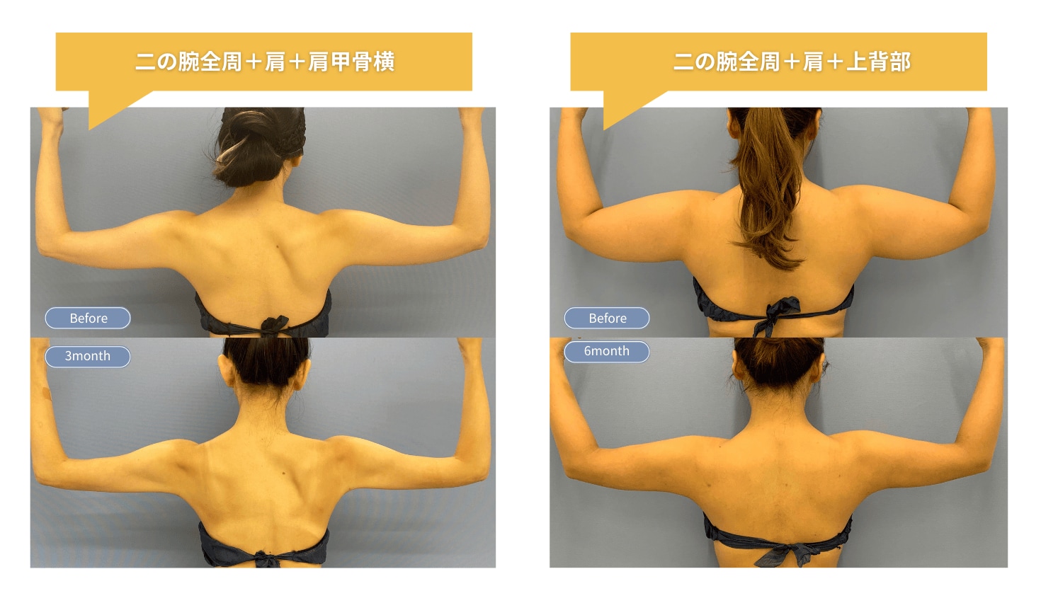 二の腕脂肪吸引