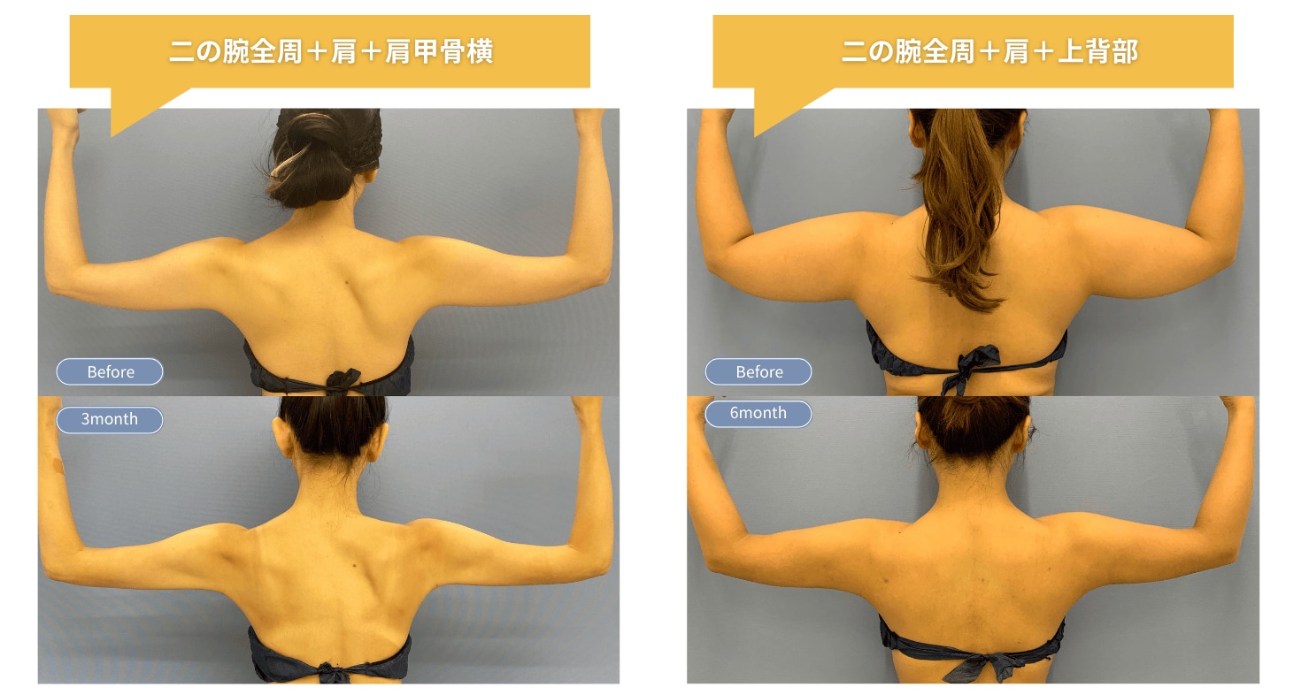 二の腕脂肪吸引