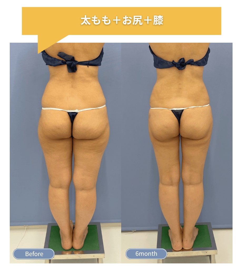 太もも・お尻 脂肪吸引