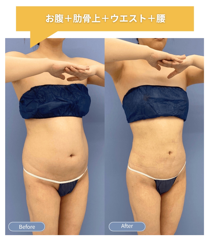 お腹脂肪吸引