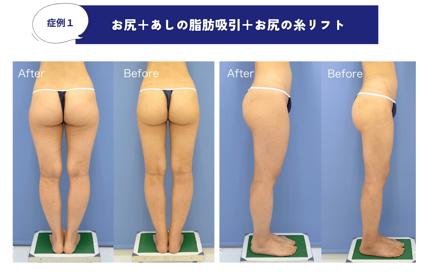 脂肪吸引＋お尻糸リフトの症例