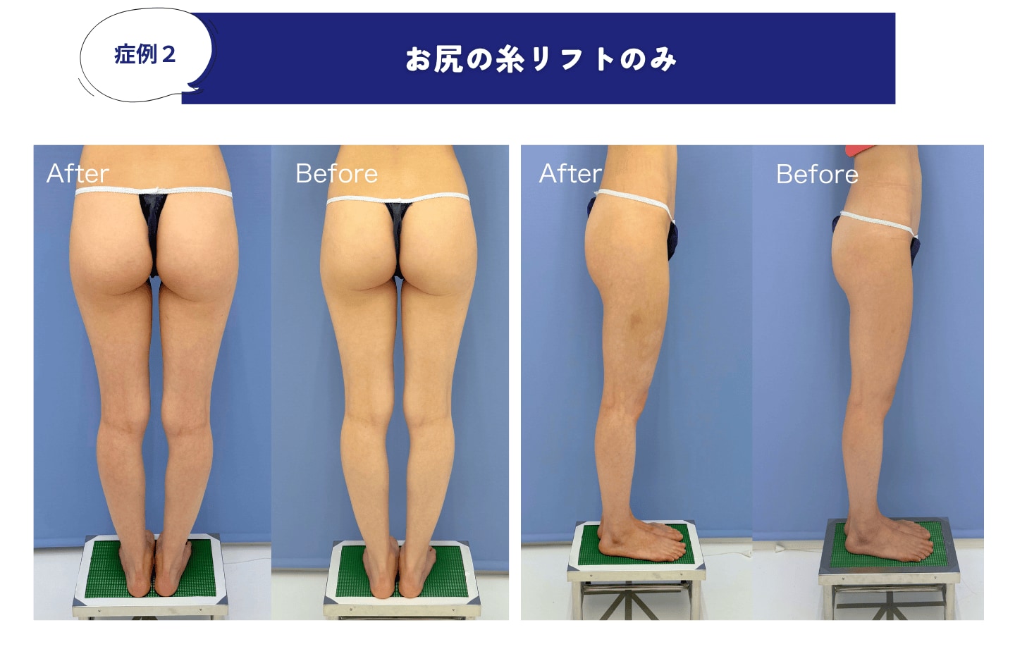 お尻糸リフトのみの症例