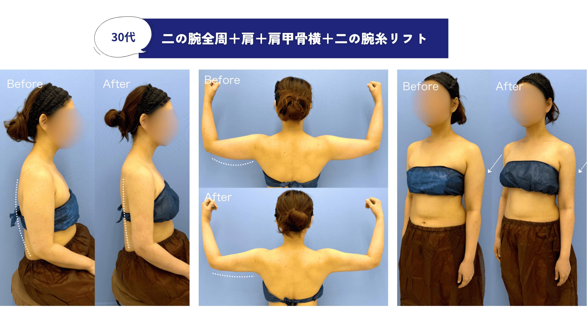 二の腕糸リフトができるのは、葛島医師だけ