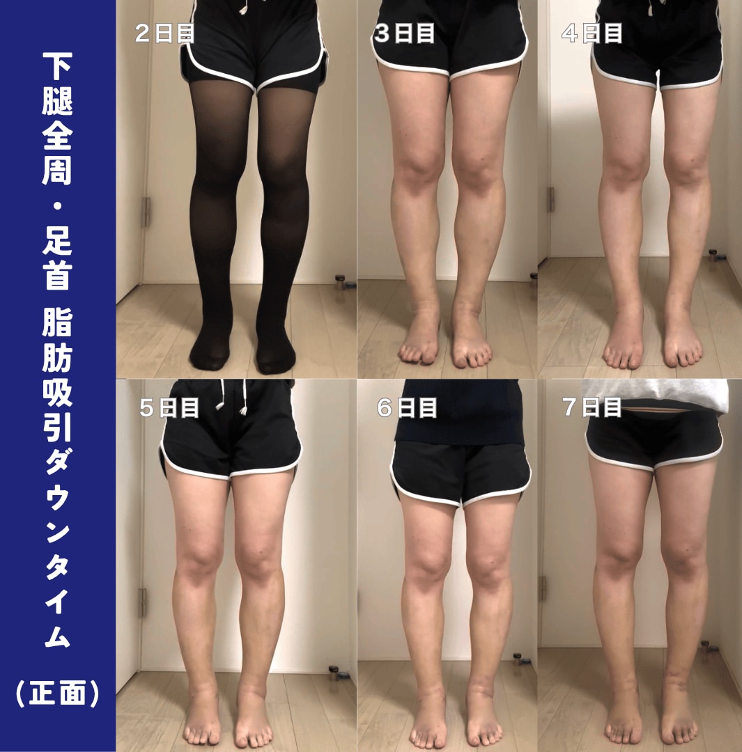 術後の腫れ・内出血を写真で解説