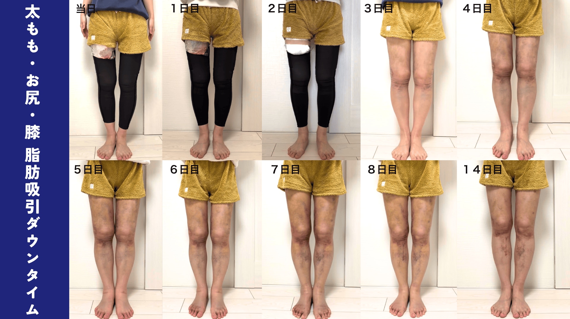 術後の腫れ・内出血を写真で解説