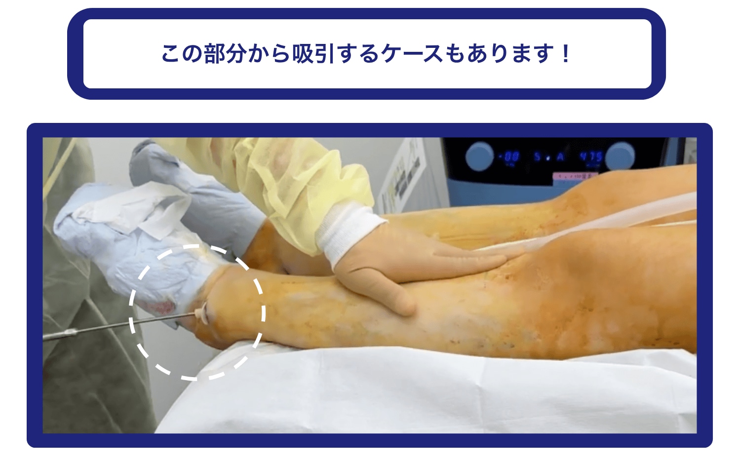 人によっては、くるぶし付近や足首から吸引することも！