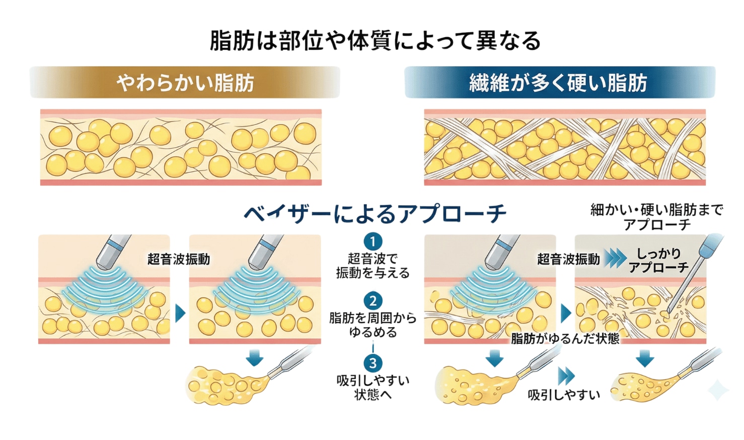 細かい・硬い脂肪までしっかりアプローチ