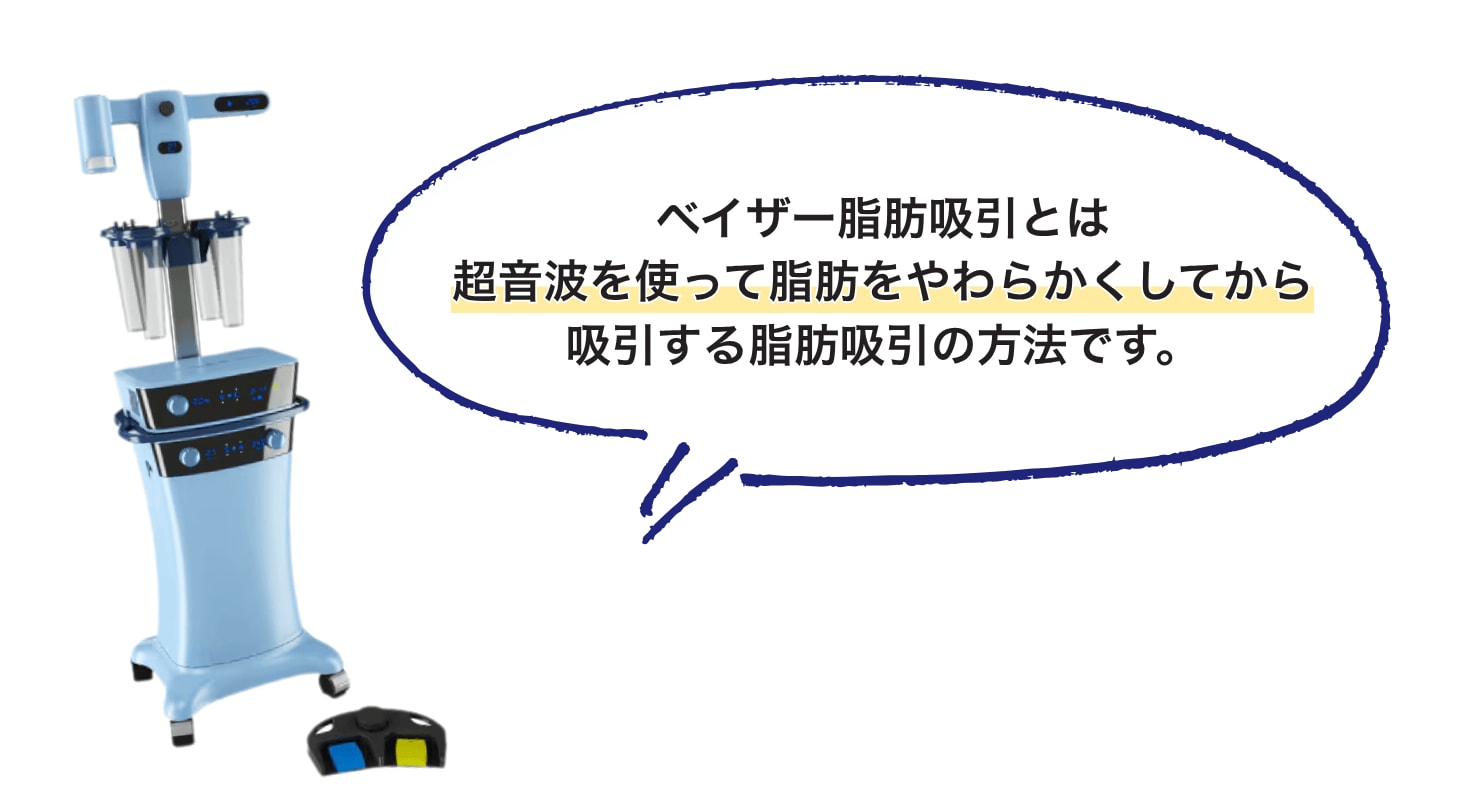 ベイザー脂肪吸引の基本