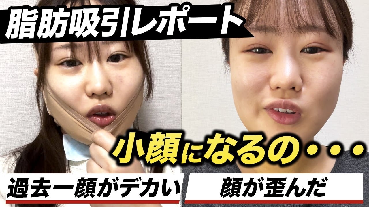 顔の脂肪吸引ダウンタイムの過ごし方は?施術を体験したスタッフに密着