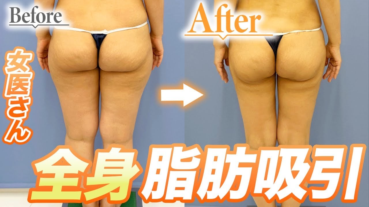 全身の脂肪吸引を一度にした女医の体験談!ダウンタイムのつらさは?