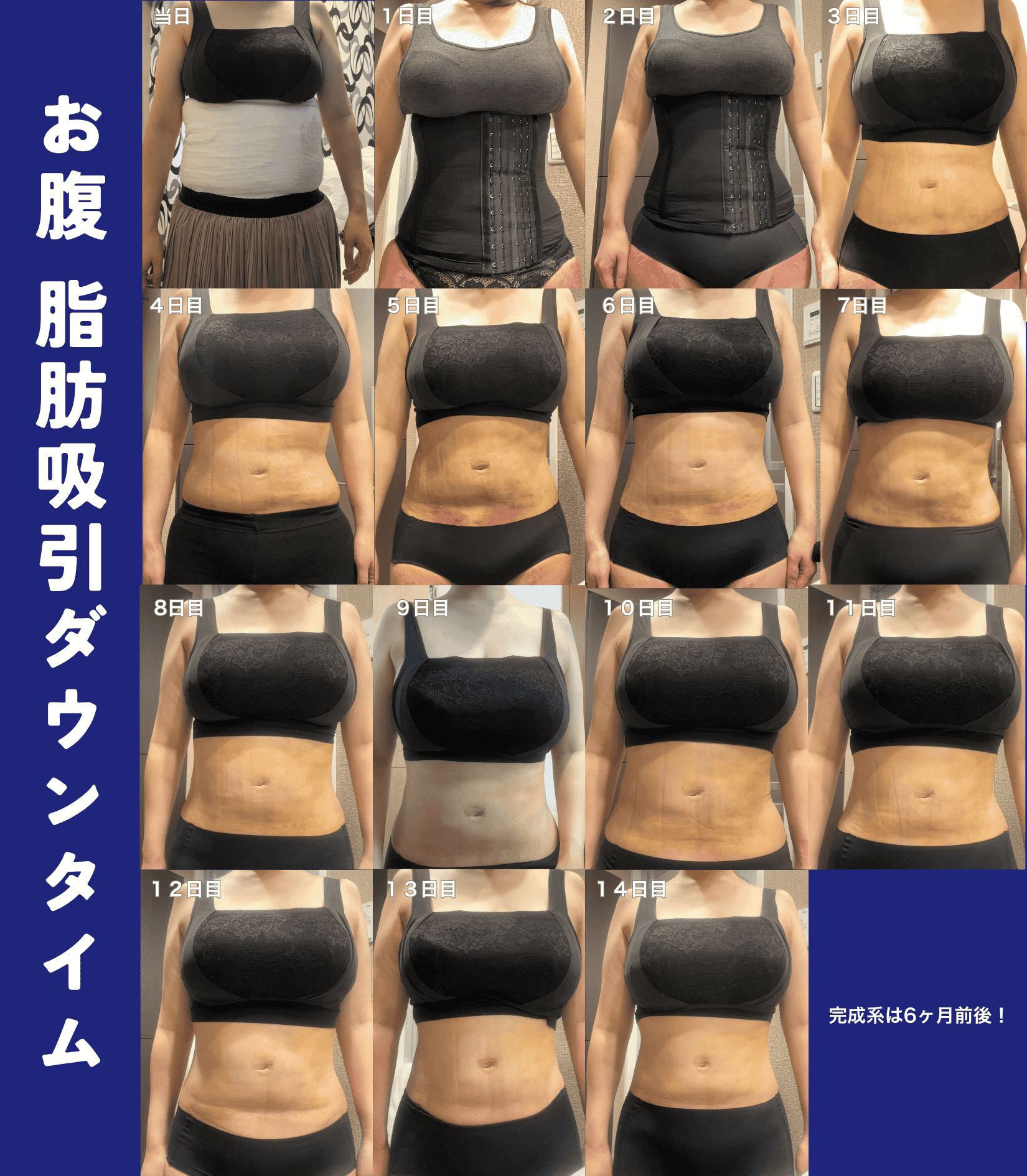 術後の腫れ・内出血を写真で解説