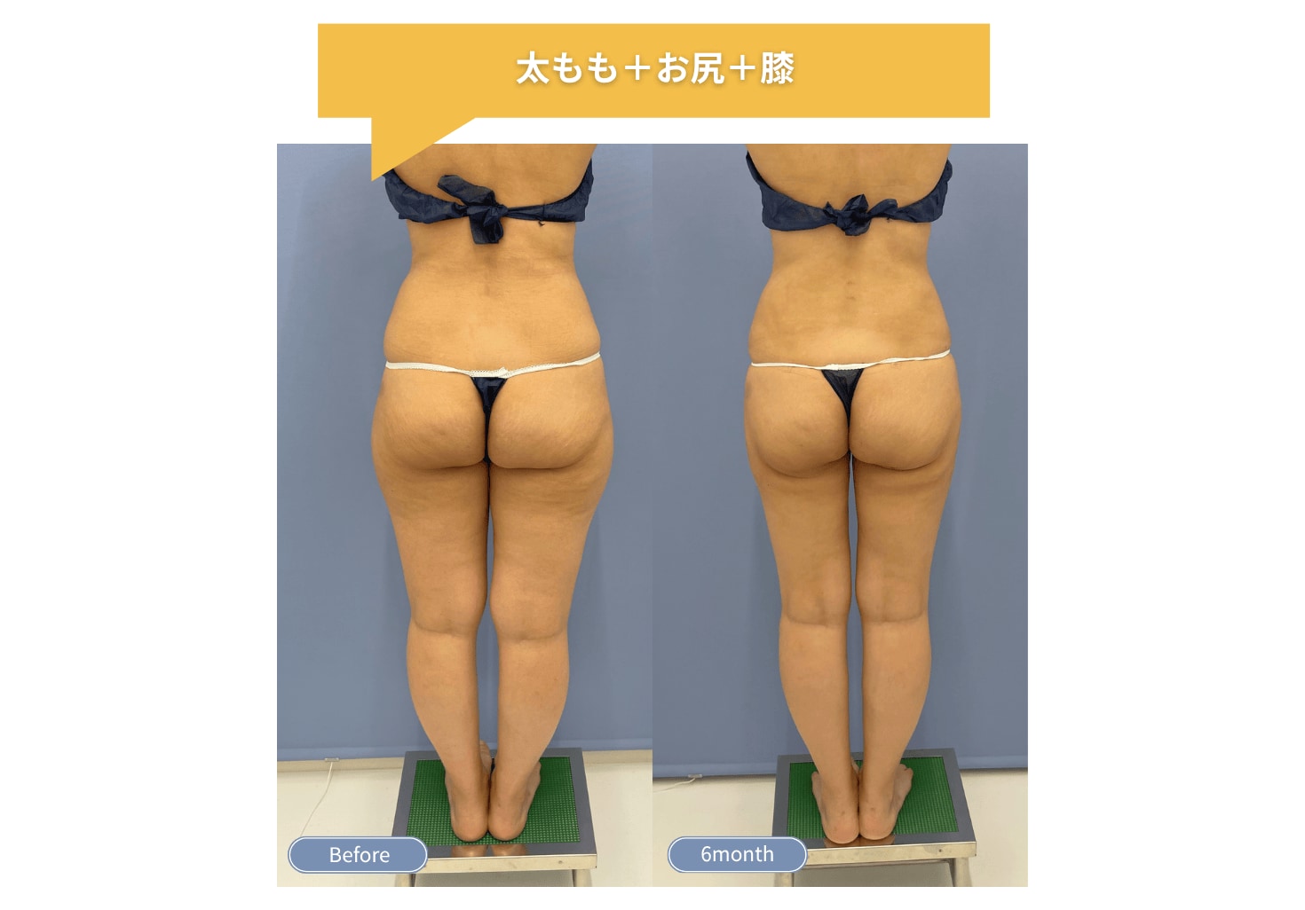 太もも・お尻 脂肪吸引