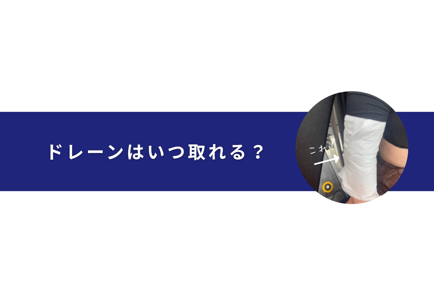 ドレーンはいつ取れる？