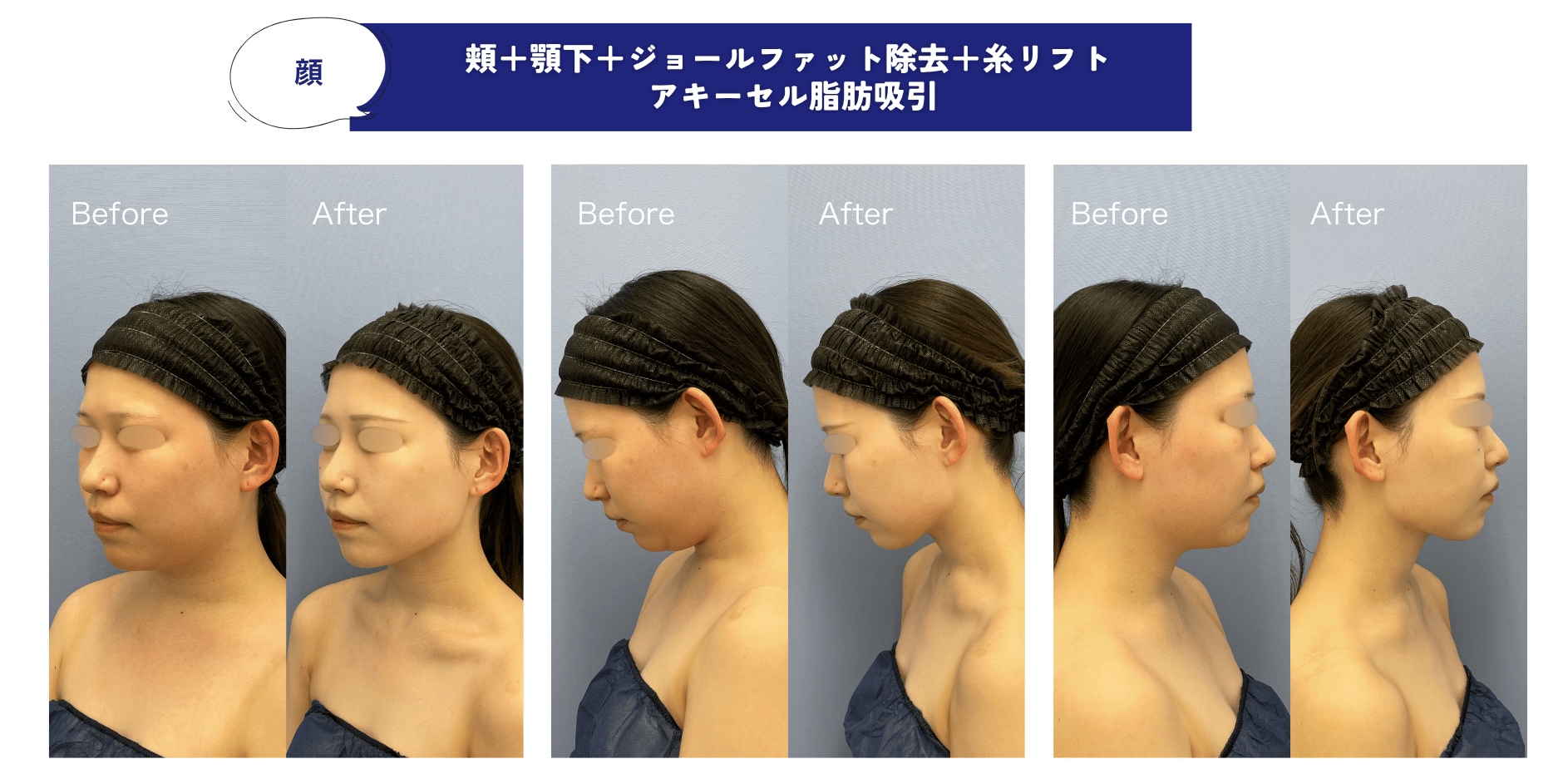 アキーセル単体のビフォーアフター