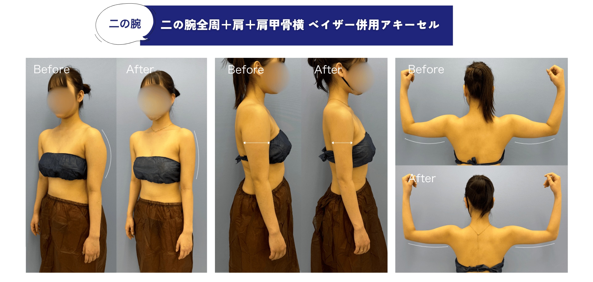 ベイザー併用アキーセルのビフォーアフター