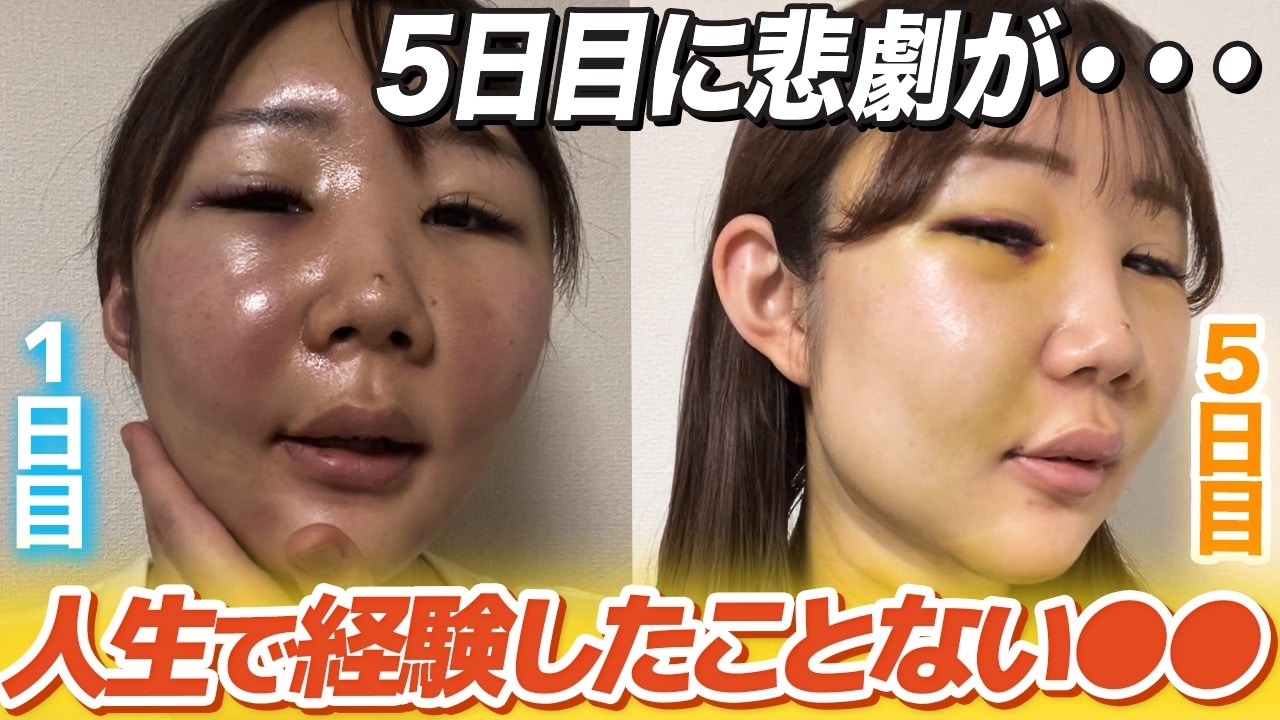顔の脂肪吸引ダウンタイム14日間レポートをお届け!気になる経過は?