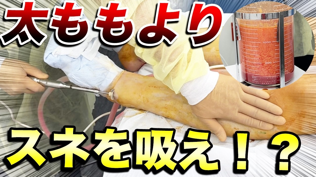 すねの肉を落とすには脂肪吸引？適応がある人の特徴を解説！