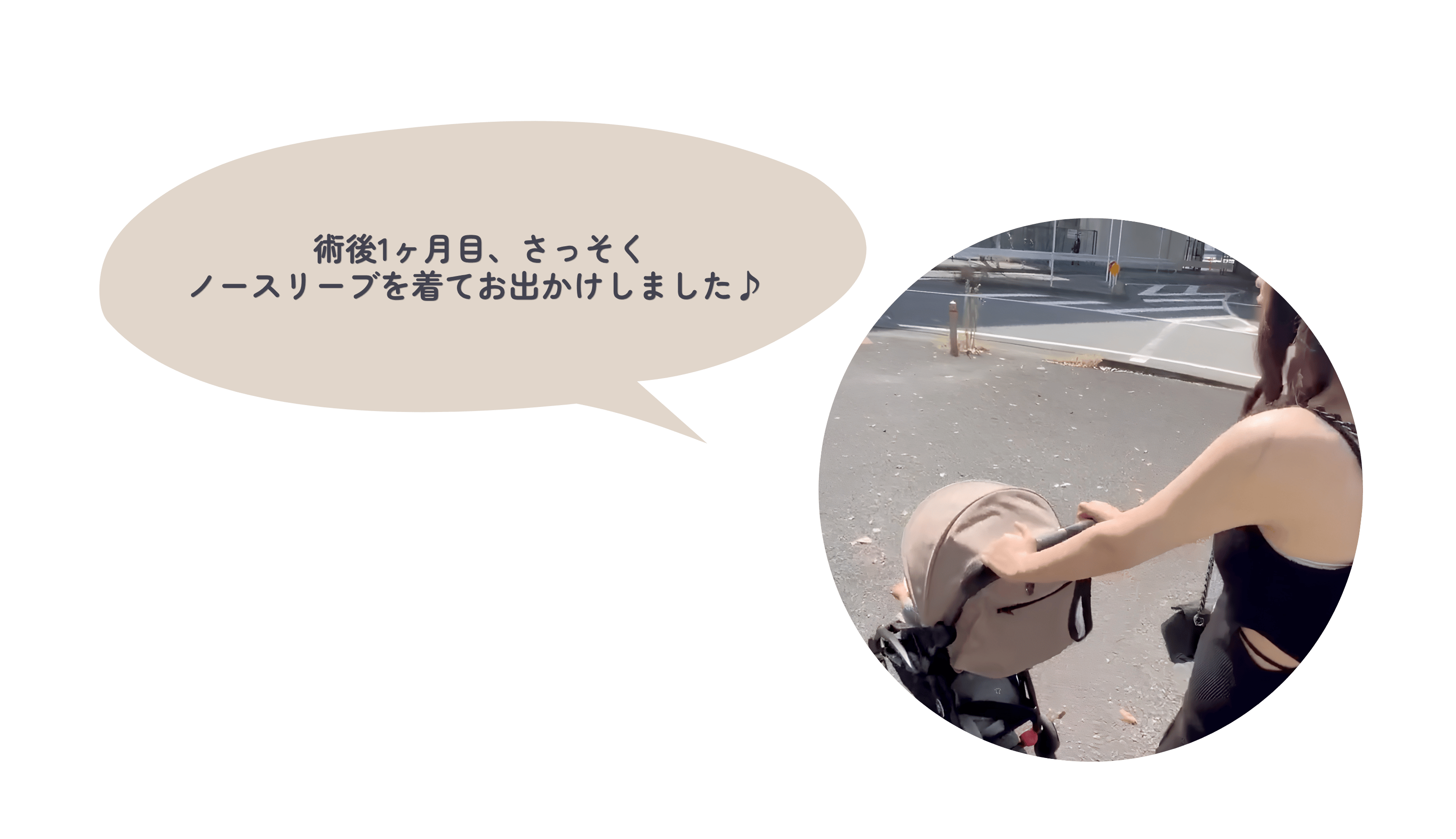 子育てしながらの二の腕脂肪吸引の感想