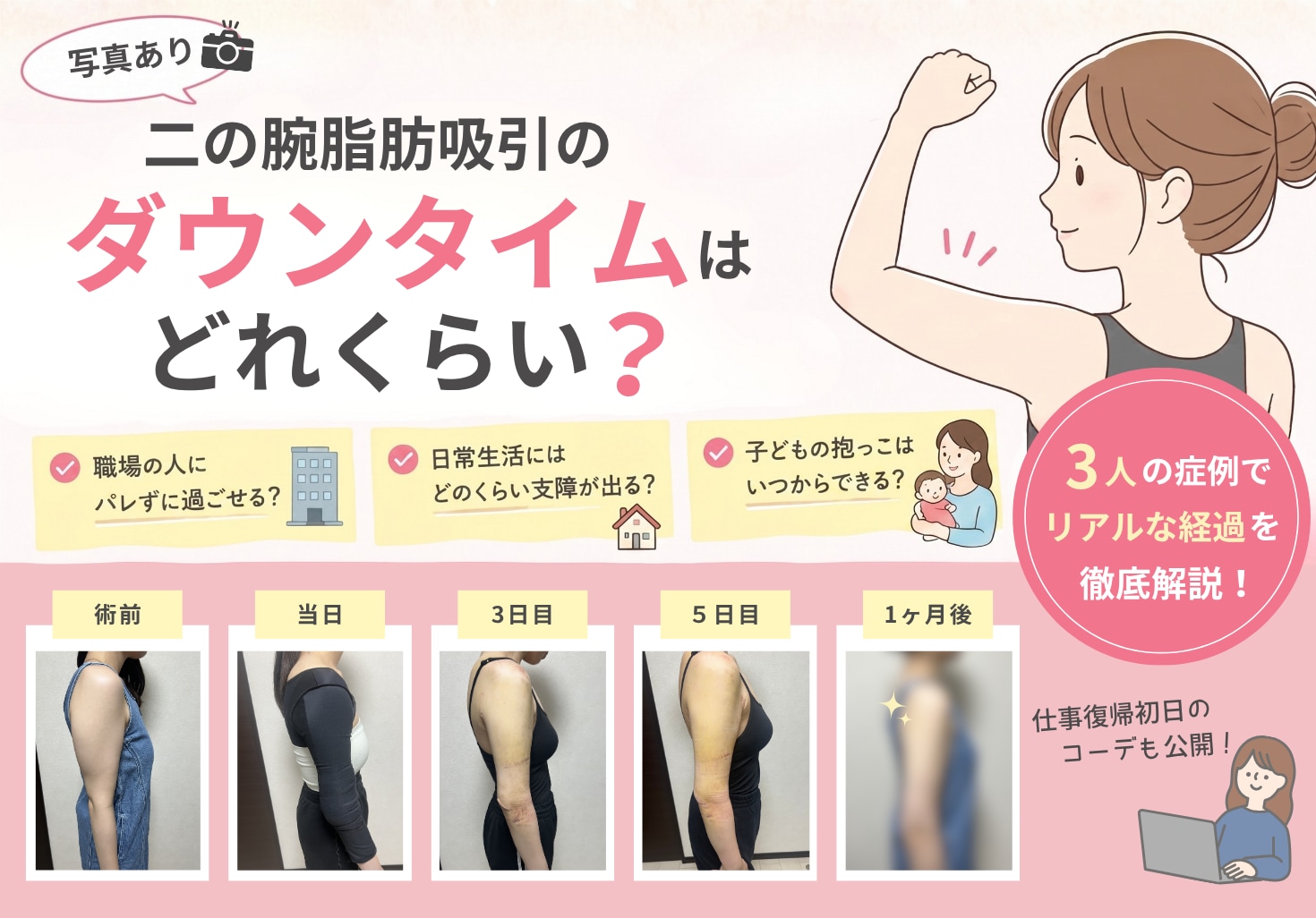 【写真あり】二の腕脂肪吸引のダウンタイムはどれくらい？仕事や子育てへの影響を3人の症例で解説