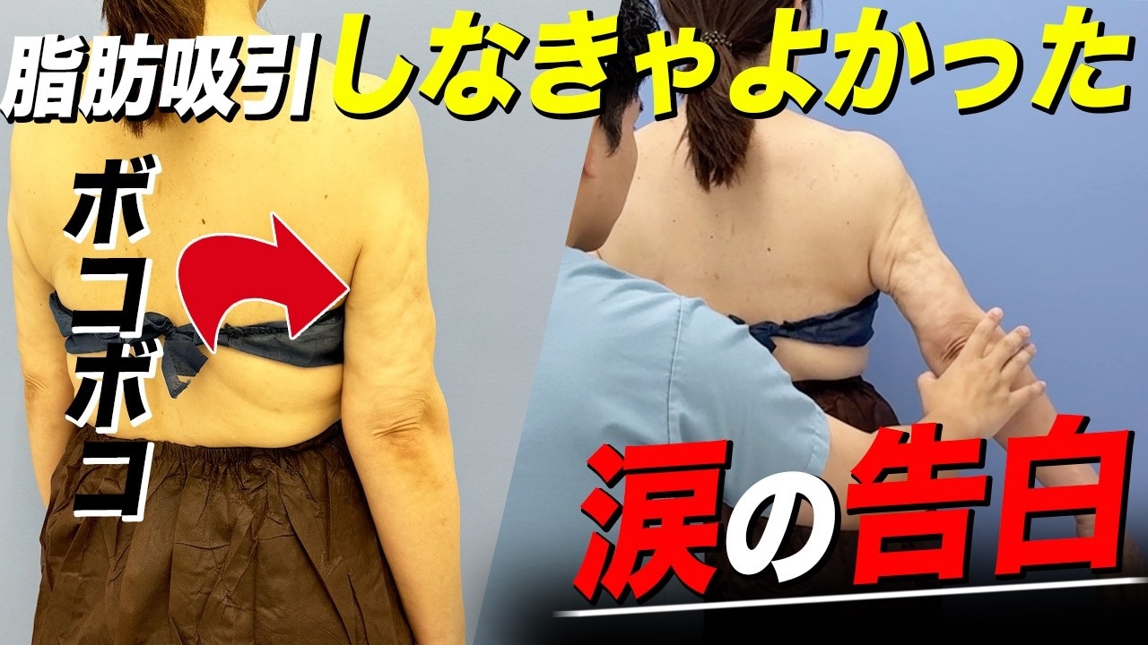 二の腕脂肪吸引の他院修正は難しい？失敗したときの対処法をお伝えし