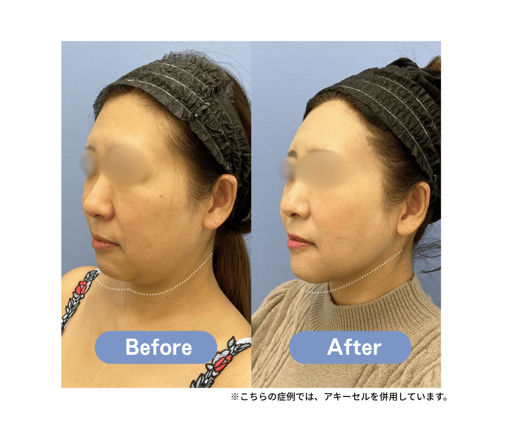 ベイザー脂肪吸引 FACE 症例写真